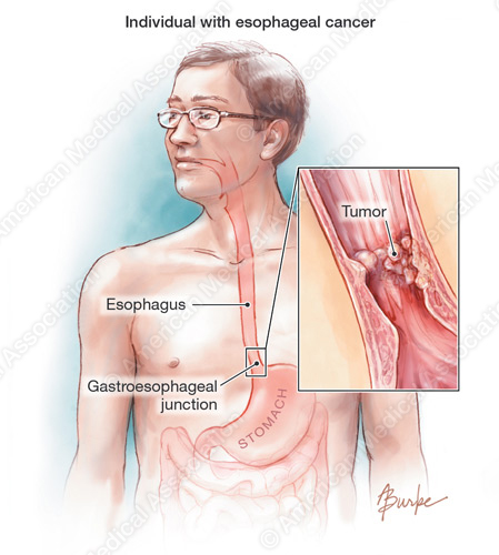 Researchers present findings on promising biomarker for esophageal cAncer